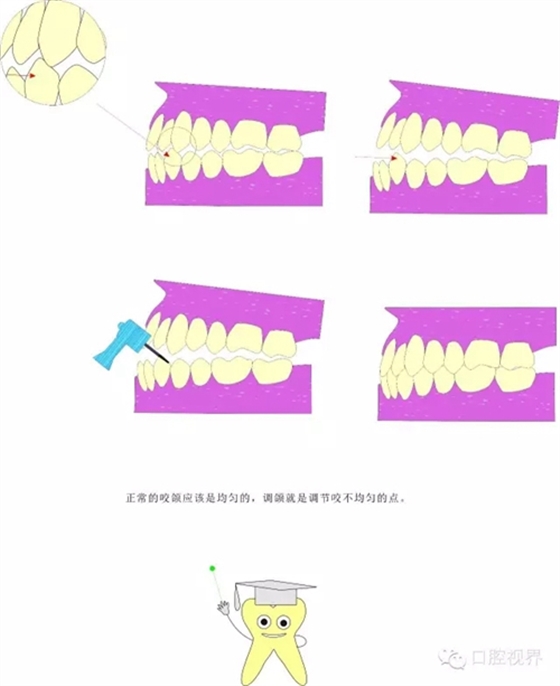 【愛牙科普知識300問】 “什么是牙間牽引？”