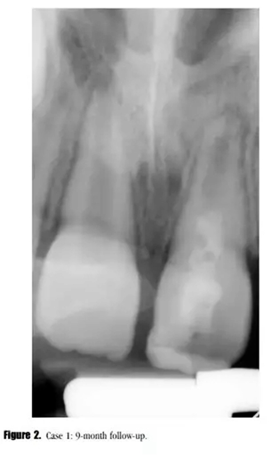 病例分享｜牙髓血管再生治療失敗后的牙根發育：2例