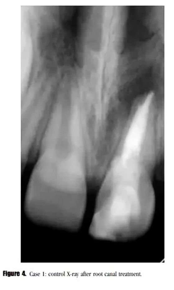 病例分享｜牙髓血管再生治療失敗后的牙根發育：2例