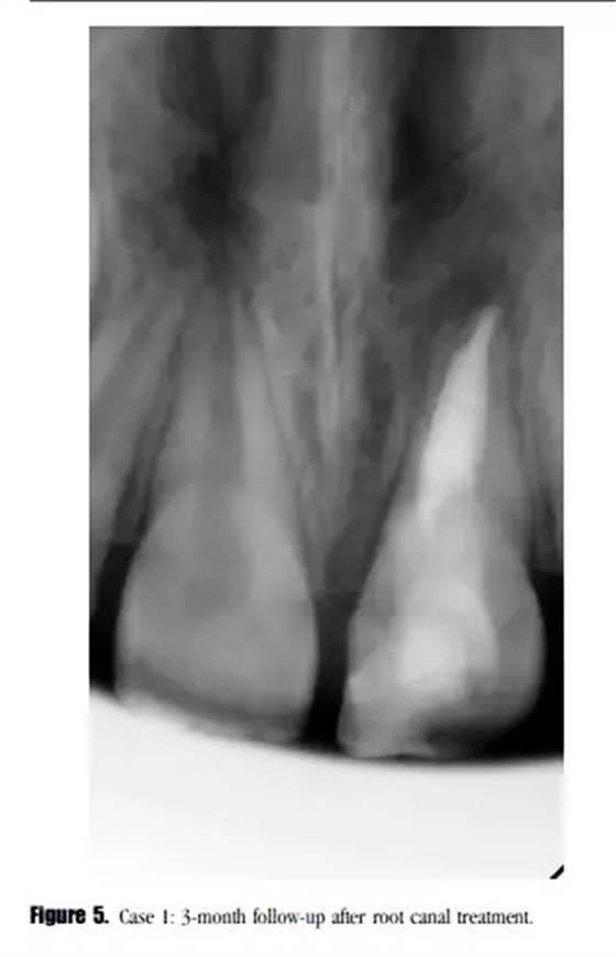 病例分享｜牙髓血管再生治療失敗后的牙根發育：2例