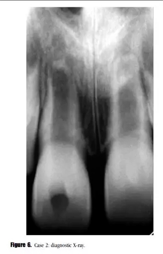 病例分享｜牙髓血管再生治療失敗后的牙根發育：2例