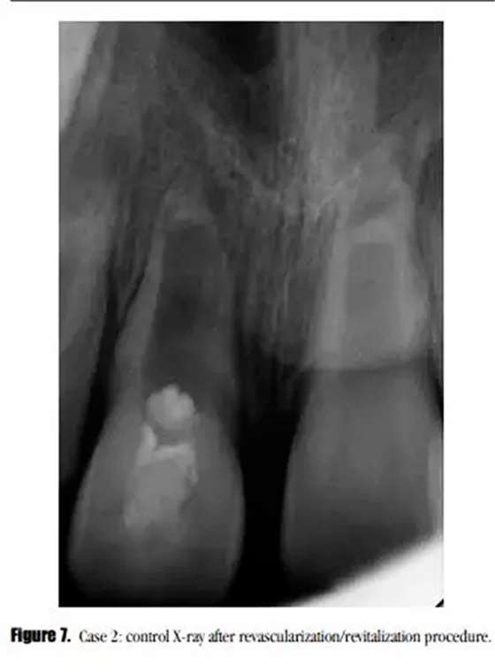 病例分享｜牙髓血管再生治療失敗后的牙根發育：2例