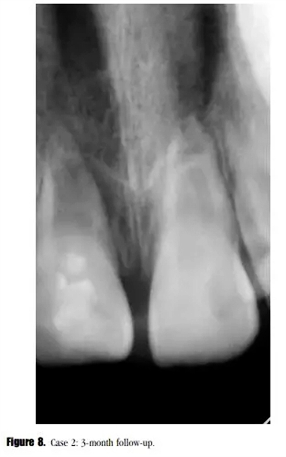 病例分享｜牙髓血管再生治療失敗后的牙根發育：2例