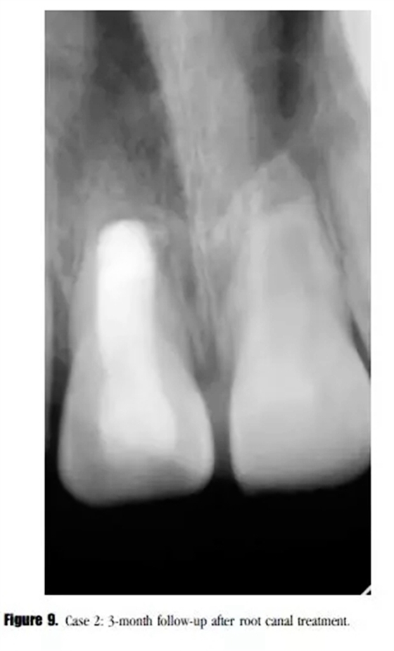 病例分享｜牙髓血管再生治療失敗后的牙根發育：2例
