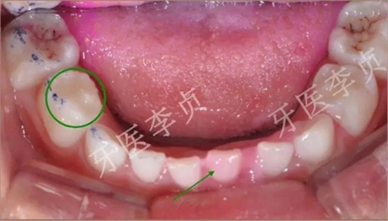 兒牙病例|兒童蛀牙的修復