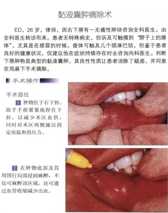 粘液腺囊腫切除術