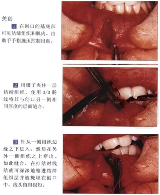 粘液腺囊腫切除術