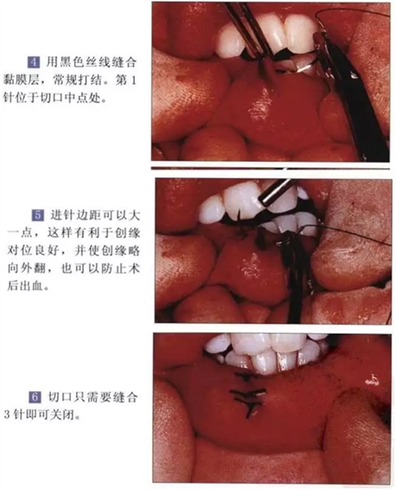 粘液腺囊腫切除術