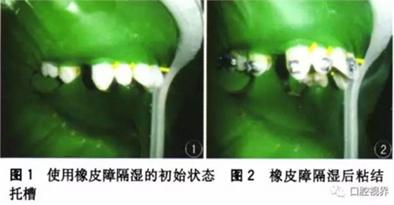 橡皮障，是用還是不用？