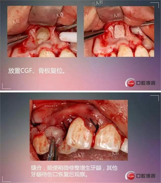 深部埋伏多生牙——微創處理  