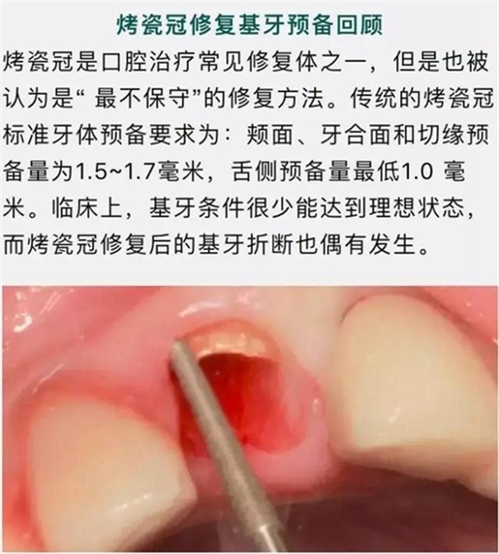 做全冠修復時基牙根面暴露，如何備牙？