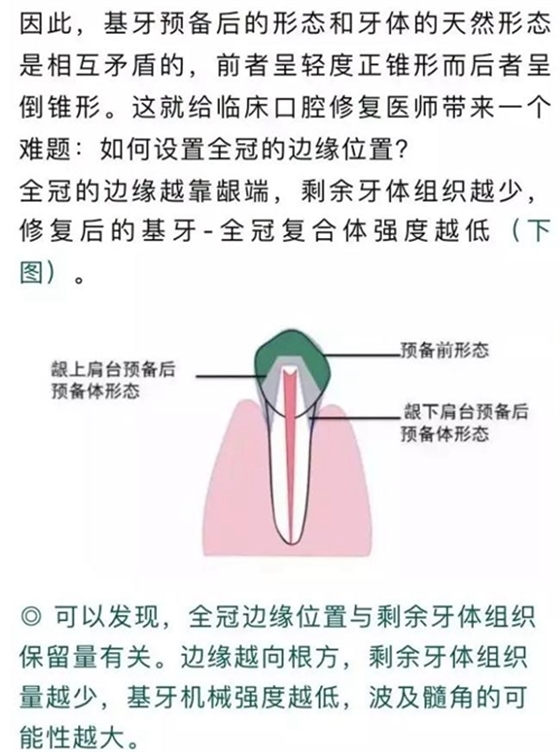 做全冠修復時基牙根面暴露，如何備牙？