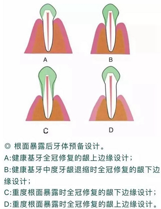 做全冠修復時基牙根面暴露，如何備牙？