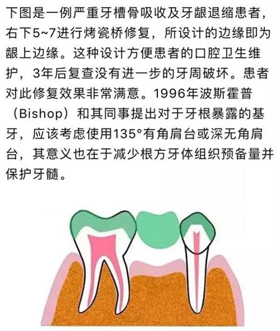 做全冠修復時基牙根面暴露，如何備牙？