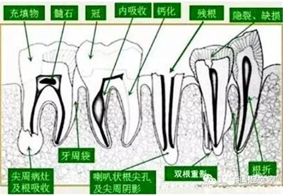 根管治療之根管口的探查要點  