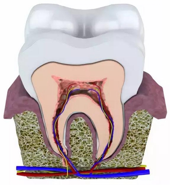 根管治療中如何避免牙根縱裂（Vertical Root Fracture,VRF）