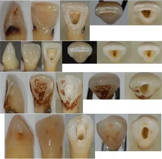 各牙齒的大概的開髓形態