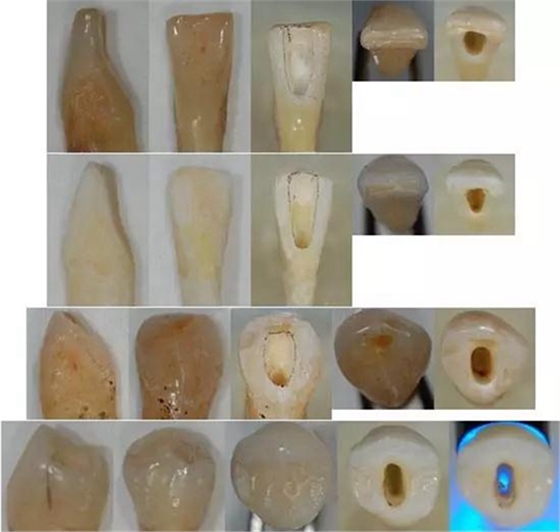 各牙齒的大概的開髓形態