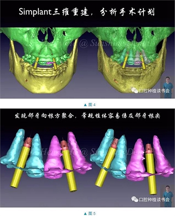 短種植體在前牙美學區應用的臨床病例報道（上）