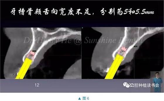 短種植體在前牙美學區應用的臨床病例報道（上）