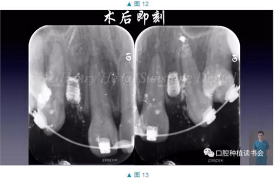 短種植體在前牙美學區應用的臨床病例報道（上）