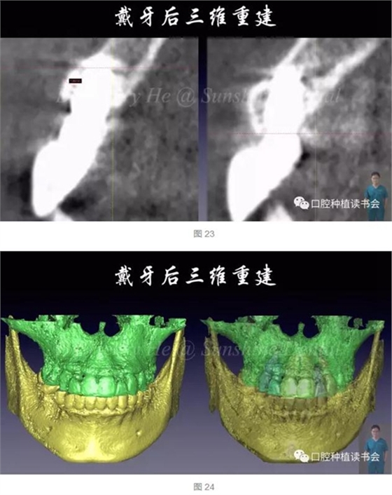 2017口腔醫師口腔組織病理之牙齦病