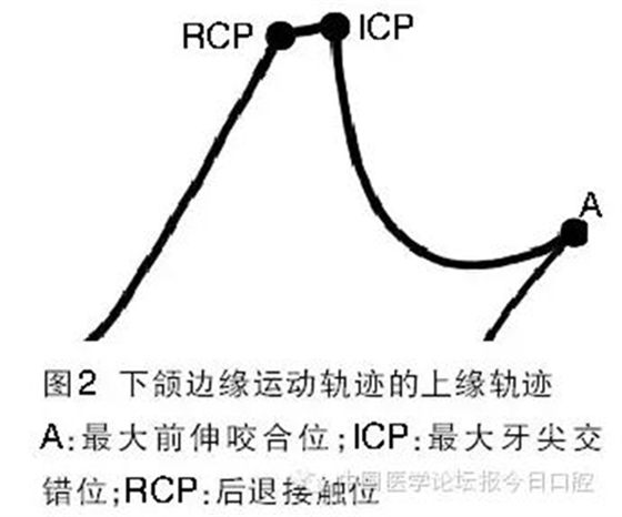 凸凹式后牙咬合接觸及其臨床意義——王美青教授