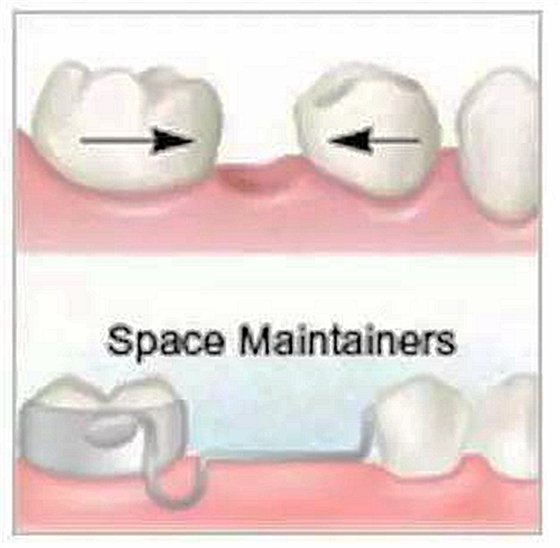 乳牙缺失致恒牙“亂長”，這個“間隙保持器”可預防