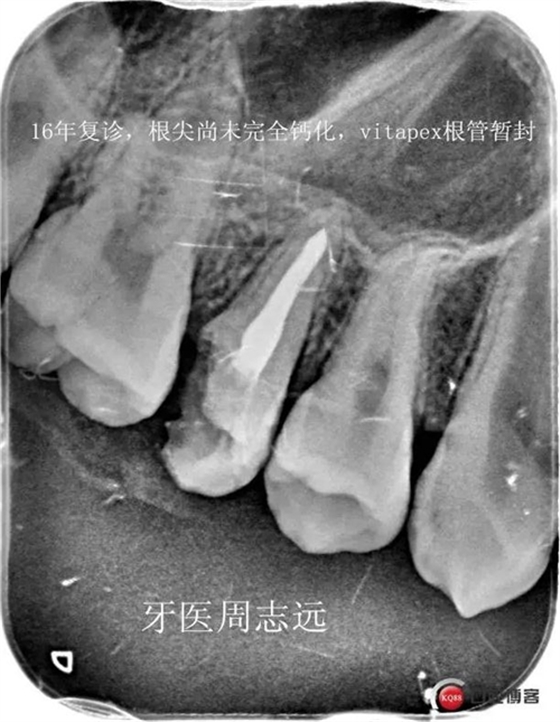 根尖誘導成型術   