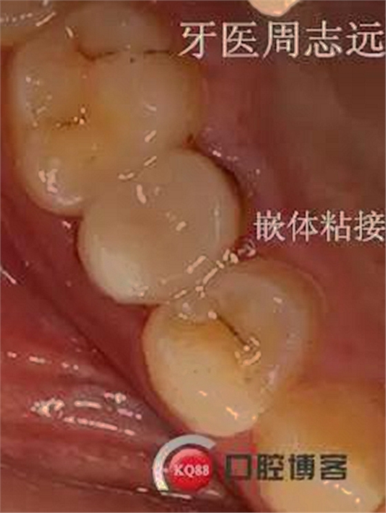 根尖誘導成型術   