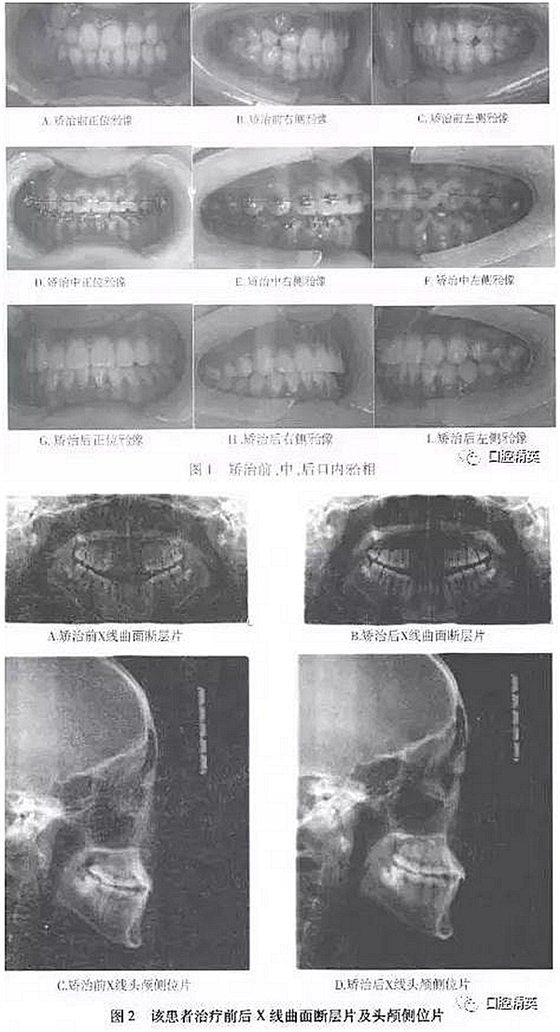 尖牙完全唇側(cè)錯(cuò)位擁擠，矯正1例  