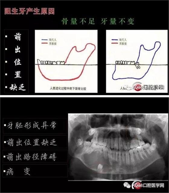 智齒拔除