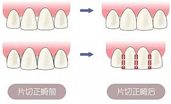 醫(yī)生方案里的鄰面去釉，究竟是什么？