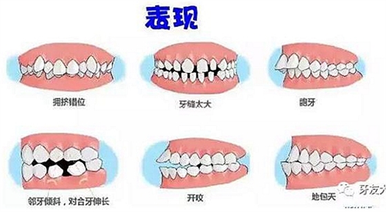 “發現即矯正”12歲前必須處理的20種兒童牙頜畸形 