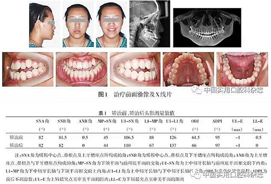 病例報告 | 上頜種植體支抗Ⅲ類牽引矯治骨性Ⅲ類反牙合伴開牙合1例報告