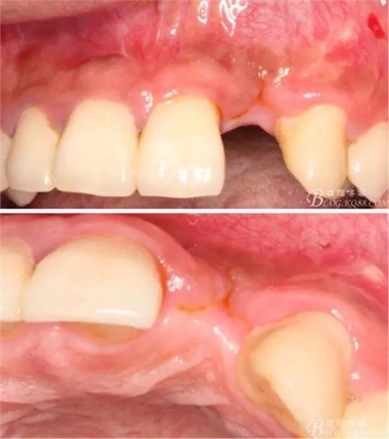 一例上前牙種植失敗病例的補救