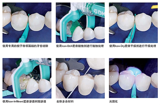 lcon愛康滲透樹脂——鄰面齲系列應用