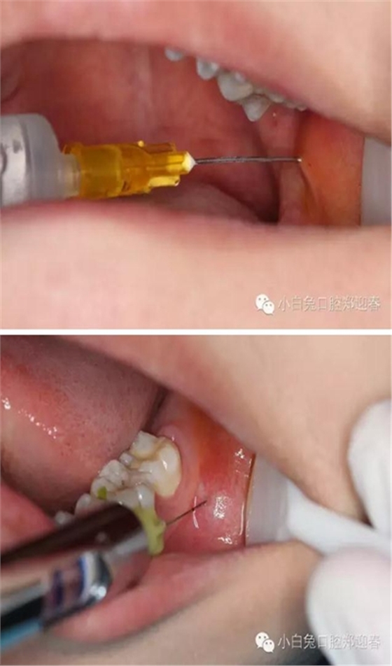 (原創)//圖解微創舒適拔牙全過程 