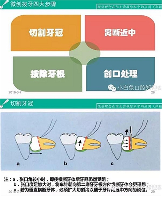 (原創)//圖解微創舒適拔牙全過程 