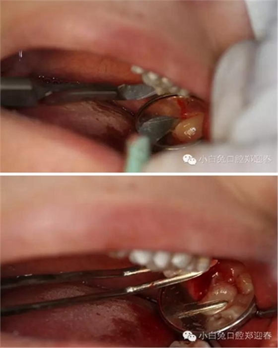 (原創)//圖解微創舒適拔牙全過程 