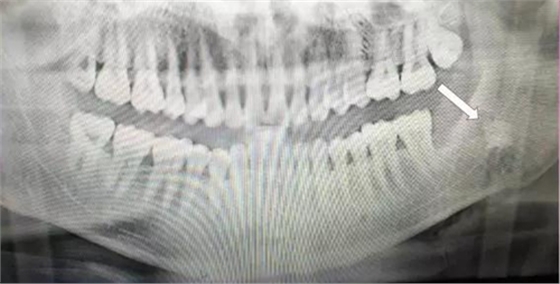 拔牙斷根的去與留？