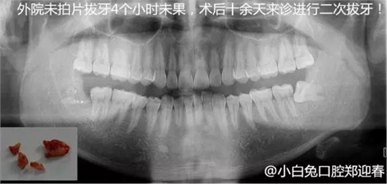 拔牙斷根的去與留？