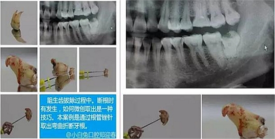 拔牙斷根的去與留？