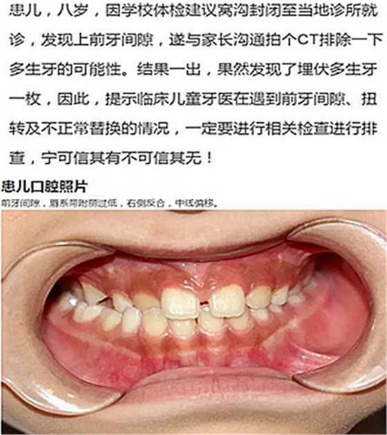 多生牙的拔除總原則：早發(fā)現(xiàn)，早處理！