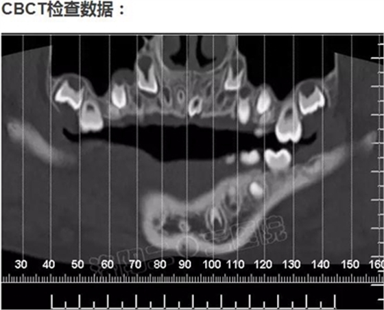 多生牙的拔除總原則：早發(fā)現(xiàn)，早處理！