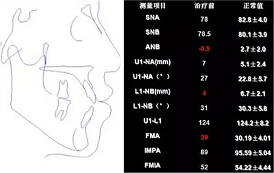 種植釘多維運(yùn)用矯正高角反頜及開頜—對(duì)羅晨醫(yī)生專訪及病例展示（上）