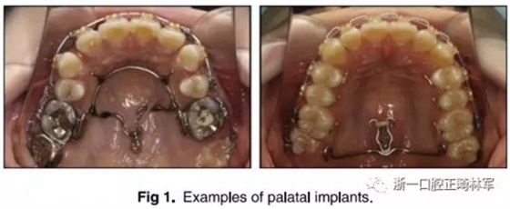 正畸文獻閱讀--上頜支抗初次植入失敗后二次植入穩定性的研究
