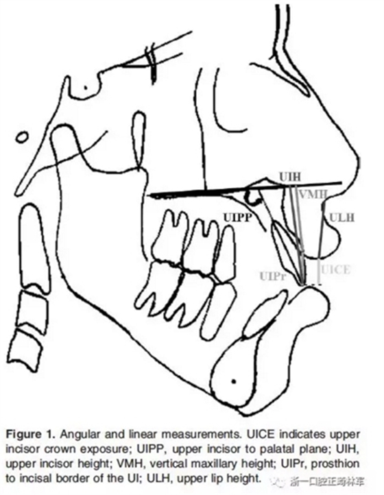 正畸文獻(xiàn)閱讀--在骨性II、III類開合中上中切牙牙冠暴露量的影響因素