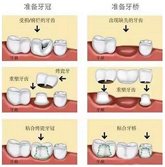 一位資深牙醫(yī)的總結(jié) | 如何減輕患者鑲牙后酸痛癥狀的措施！