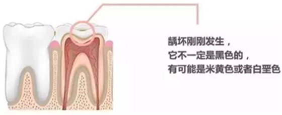 【收藏】關于補牙，知道這些就夠了！